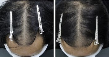 Comparison before and after using Hisooth H3 Scalp Massager with Red Light Therapy