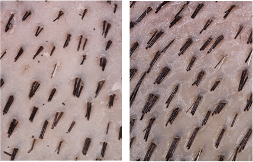 Comparison Before and After usage of Hisooth H3 Hair Regrowth Massager Cap